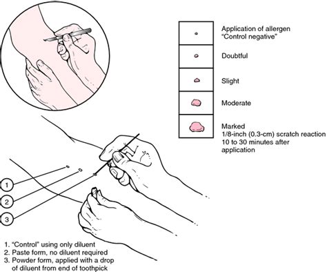 scratch test nursing definition|how long before scratch test.